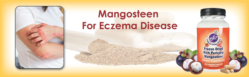 Eczema
